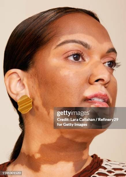 8,486 Vitiligo Stock Photos & High